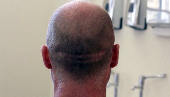 EUT Hair Restoration Surgery