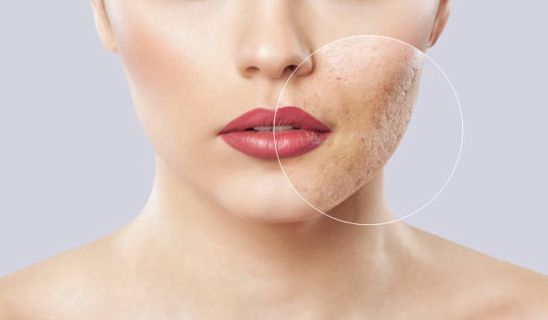 Pore Perfect: Expert Treatments in Riyadh