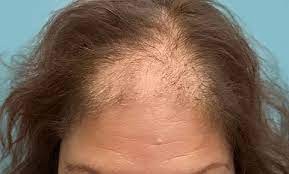 Hair Transplant Clinic in UAE At Royal Clinic