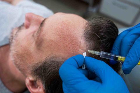 Take Off with Your Hair Transformation Adventure: PRP Treatment in Dubai