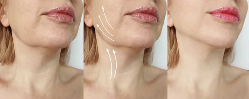 Dubai's Best-Kept Beauty Secret: The Power of Neck Lifts