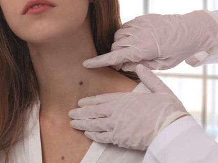 Mole Removal Treatment in Dubai: Expert Tips and Direction