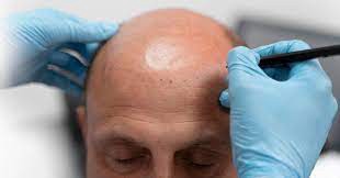 Experience a Life-Changing Transformation with FUE Hair Transplant in Dubai