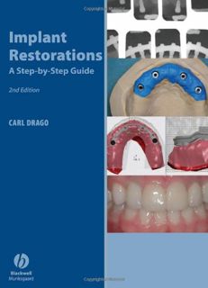 READ EPUB KINDLE PDF EBOOK Implant Restorations: A Step-by-Step Guide by  Carl Drago &  Thomas Peter