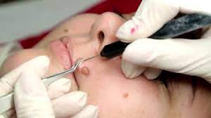 10 Essential Steps for Optimal Results with Mole Removal Treatment in Dubai