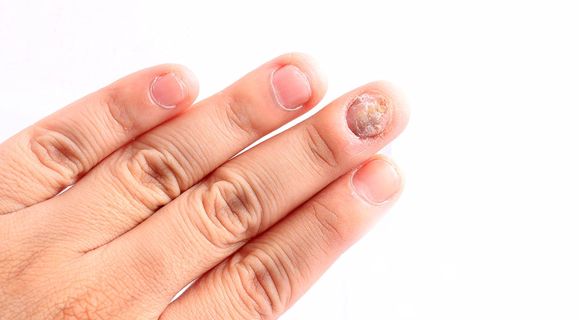 nail infection treatment for use Loceryl Nail Lacquer