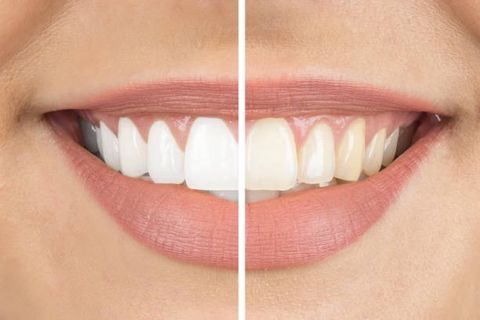 Teeth Whitening in Riyadh: Your Questions Answered