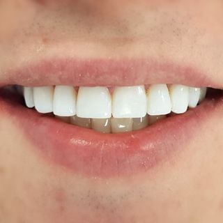 Teeth Whitening in Dubai: Luxury or Necessity?