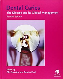[Access] [EBOOK EPUB KINDLE PDF] Dental Caries: The Disease and Its Clinical Management by  Ole Feje
