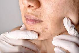 Combination Therapies for Melasma in Dubai