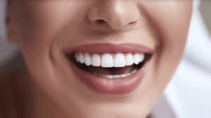 Affordable Dental Veneers in Dubai What to Expect