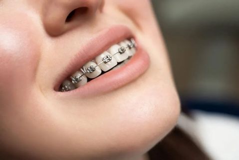 Types of Dental Braces Available in Dubai and Their Costs