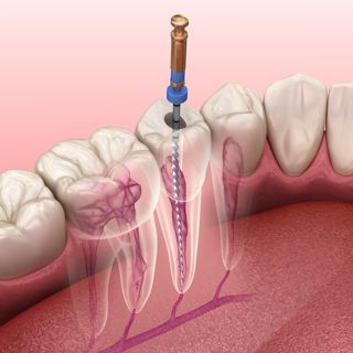 Root Canal vs. Crown: Restoring Your Tooth After Treatment