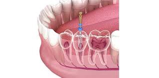 Innovations in Root Canal Treatment: What's New?