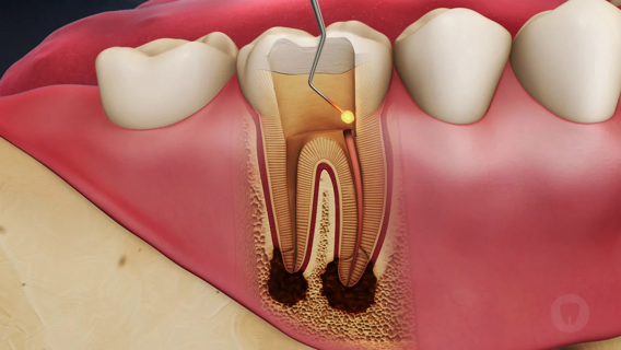 Alternative Therapies to Root Canal Treatment Available in Dubai