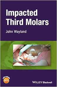 [GET] EBOOK EPUB KINDLE PDF Impacted Third Molars by John Wayland 📖