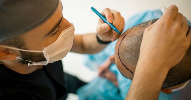 Why Hair Transplant Costs in Dubai Vary