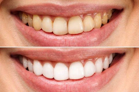 Brighten Your Smile: Teeth Whitening in Riyadh