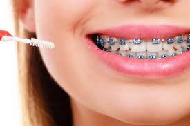 What to Expect at the Best Dental Braces Clinic in Town