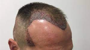 Things to Know Before Getting Hair Transplant