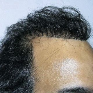 Scalp Micropigmentation Cost Versus Hair Surgery?