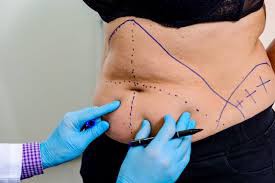 Liposuction Dubai: The Ultimate Guide to Body Contouring