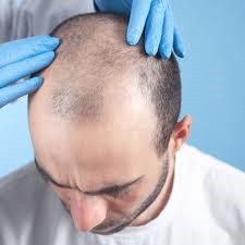 How to Prepare for Your Hair Transplant Consultation in Dubai