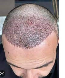 Sunscreens for Scalp Protection After Hair Transplant in Dubai