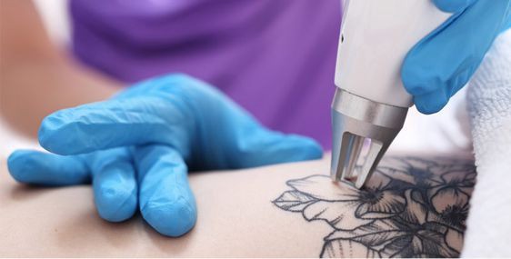 Benefits of Choosing Picosure for Tattoo Removal in Dubai