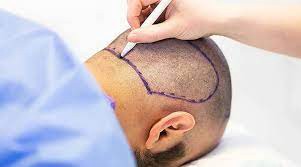 After PRP & Hair Transplant Surgery in Dubai UAE