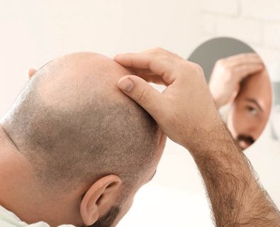 Affordable Hair Transplant Costs in Dubai: A Guide