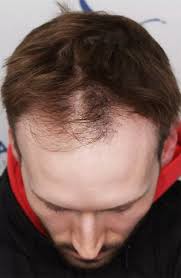 Affordable Hair Transplant Costs in Dubai: Explained