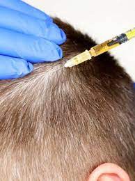 Tips for Maintaining PRP Hair Results & Hair transplant Surgery