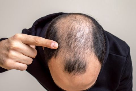 Managing Expectations with Finasteride for Hair Loss in Dubai