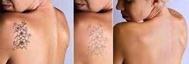 PicoSure Tattoo Removal in Dubai Step-by-Step Guide