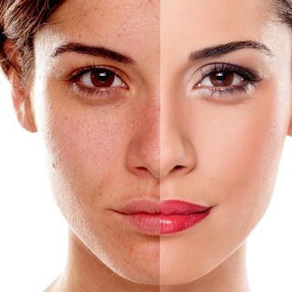 Say Goodbye to Uneven Skin: Pigmentation Treatment Unveiled