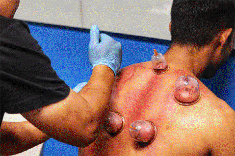 The Economics of Hijama in Dubai