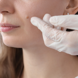 Mole Removal for Athletes: Skincare Tips