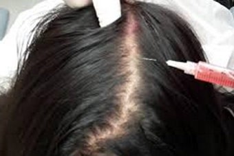 PRP Hair Therapy in Dubai: Thicker Hair After Baby