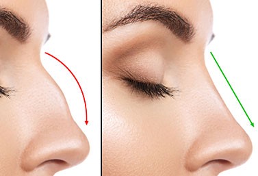 Recovery After Rhinoplasty in Dubai What You Need to Know