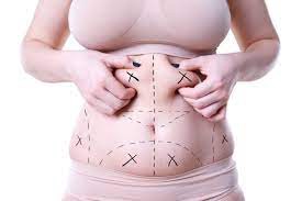 How Tummy Tuck  Muscat Can Address Post-Surgical and Post-Pregnancy Abdomen Issues