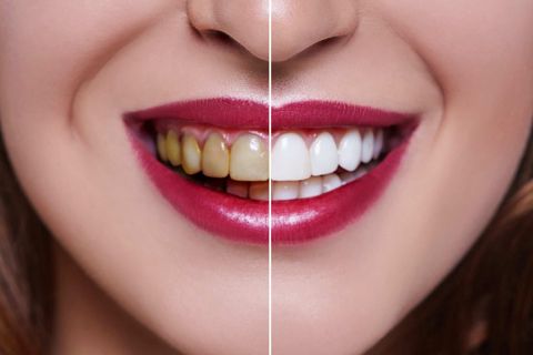 Get the Perfect Smile Dubai Best Teeth Whitening Options