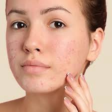 Acne Treatments for Adults: Effective Solutions Available in Dubai