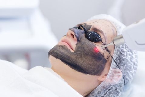 Benefits of Spectra Laser Carbon Peel