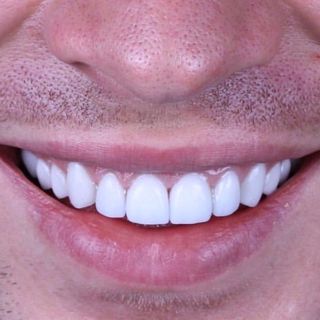 How to Prepare for Teeth Whitening Treatments in Dubai