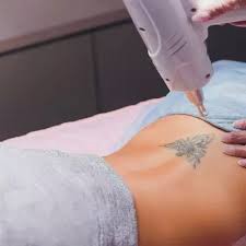 Navigating the Recovery Process After Laser Tattoo Removal in Dubai