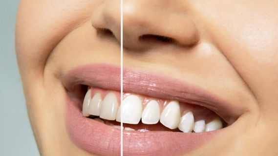 The Importance of Choosing a Skilled Teeth Whitening Dentist