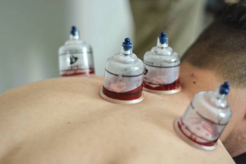 Riyadh's Best Kept Secret: Cupping Therapy Revealed