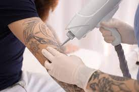 Post-Treatment Healing: What to Watch for After Laser Tattoo Removal in Dubai