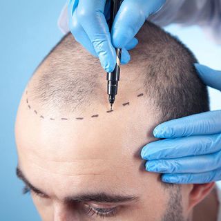 Success Stories: Real Results from the Best Hair Transplant Surgeries